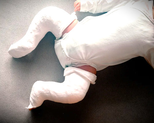 Pes Ekinovarus - Çocuk Çarpık Ayak Alçılama